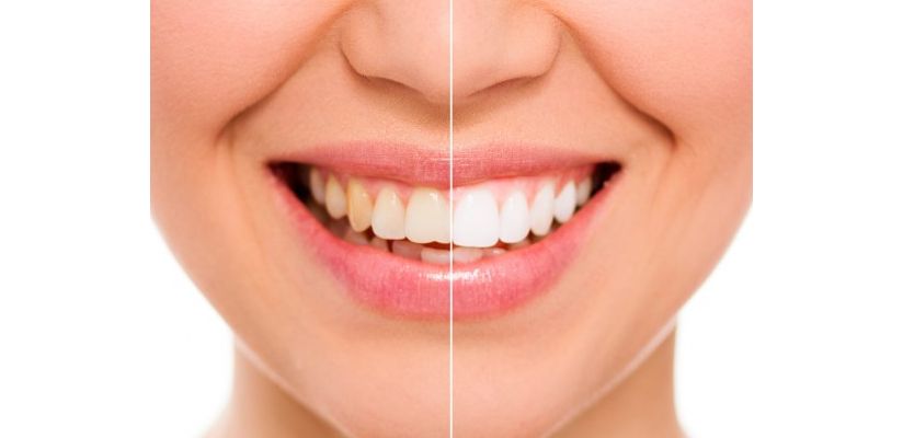 Veilig uw tanden bleken nu ook in Tiel en Empel!